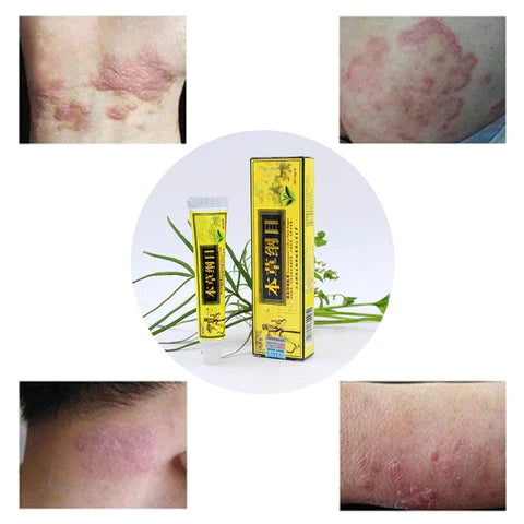 Crema herbaria natural avanzada original para psoriasis y eczema